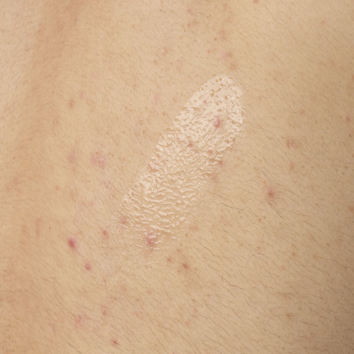 Salicylic Acid Body Serum Targeted Serum Care X4